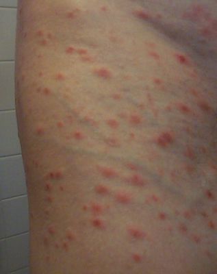 Pityriasis Lichenoides et Varioliformis Acuta.