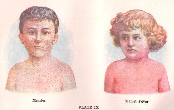 Illustrations from 1908 demonstrating the difference between the rashes of measles and scarlet fever.