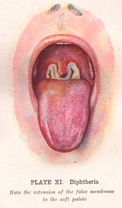 An illustration of the tonsillar pseudomembrane in diphtheria.