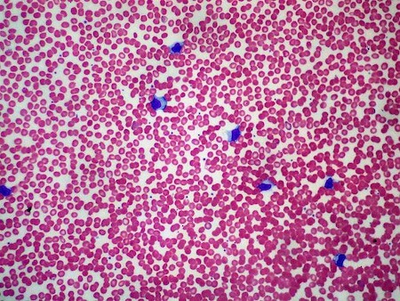 Infectious mono, peripheral smear, low power showing lymphocytosis. 16-year-old male with pharyngitis and positive MonoTest.