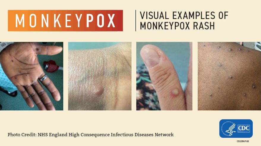 Visual examples of mpox lesions