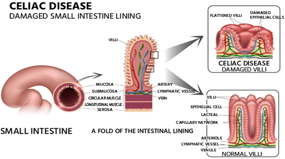 Celiac disease produces damage to epithelial cells of the intestine.