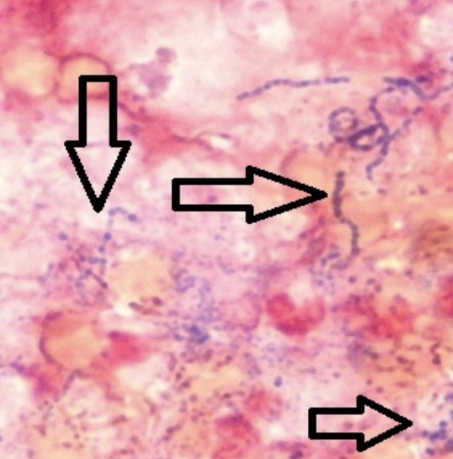 Gram stain of S. anginosus.