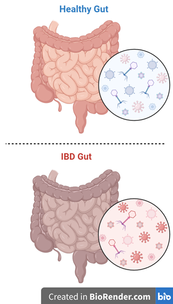 The gut virome of patients with IBD differs from healthy individuals