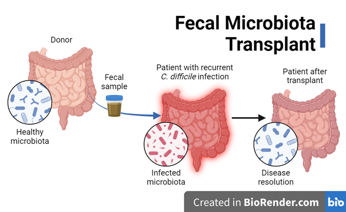 fecal microbiota transplant procedure