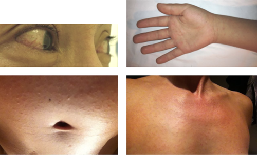 Zika-associated conjunctivitis and rash. “Top left photo courtesy of H. P. Mallet, Department of Health of French Polynesia; top right, bottom left, and bottom right photos by V. M. Cao-Lormeau and E. Grange, Institut Louis Malardé